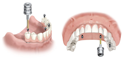 Implantologie - All-On-4™ - © nobelbiocare.com